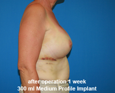 plastic-surgery-breast-augmentation